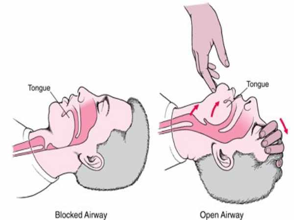 Hướng dẫn sơ cứu đúng cách cầu thủ bị nuốt lưỡi